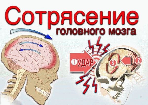 Что такое сотрясение мозга и как оно возникает